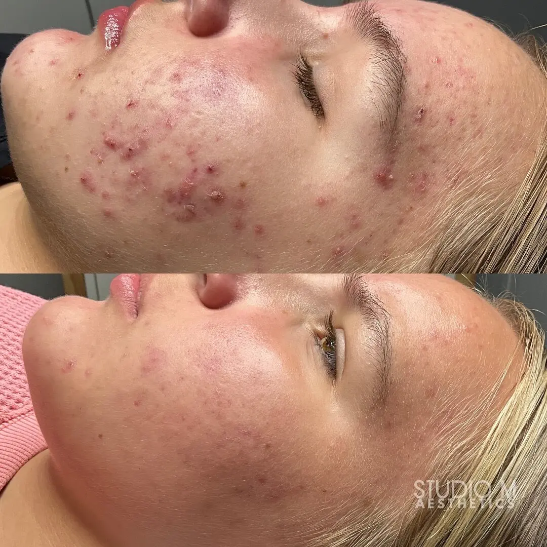 Side-by-side images show a person's face with noticeable acne in the first image and clearer skin in the second, highlighting a skin treatment's before-and-after effect.