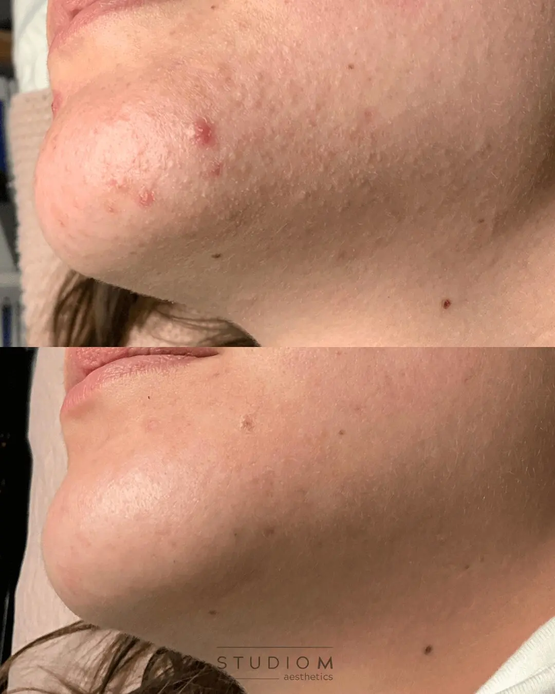 Side-by-side comparison of a person's chin before and after skin treatment, showing improvement in acne and skin texture.