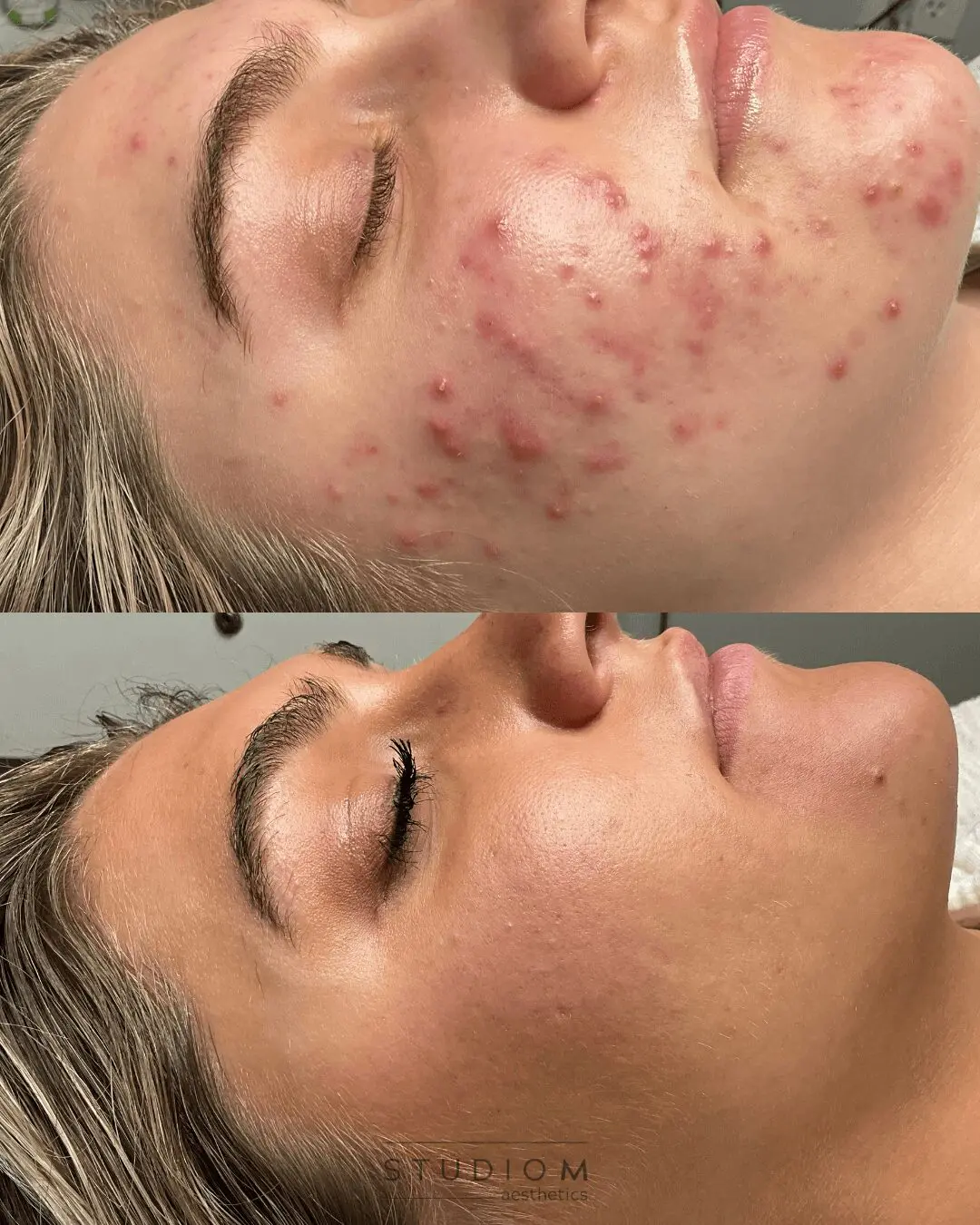 Before and after images of a person's face showing significant reduction in acne and clearer skin.