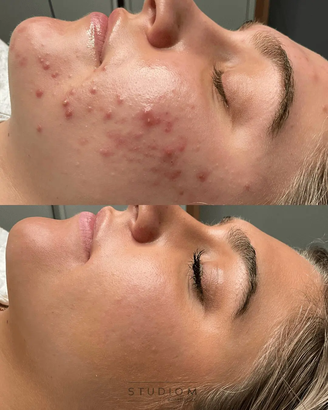 Close-up of a person's face showing significant improvement in skin condition before and after treatment. Top image shows acne, bottom image shows clear skin.