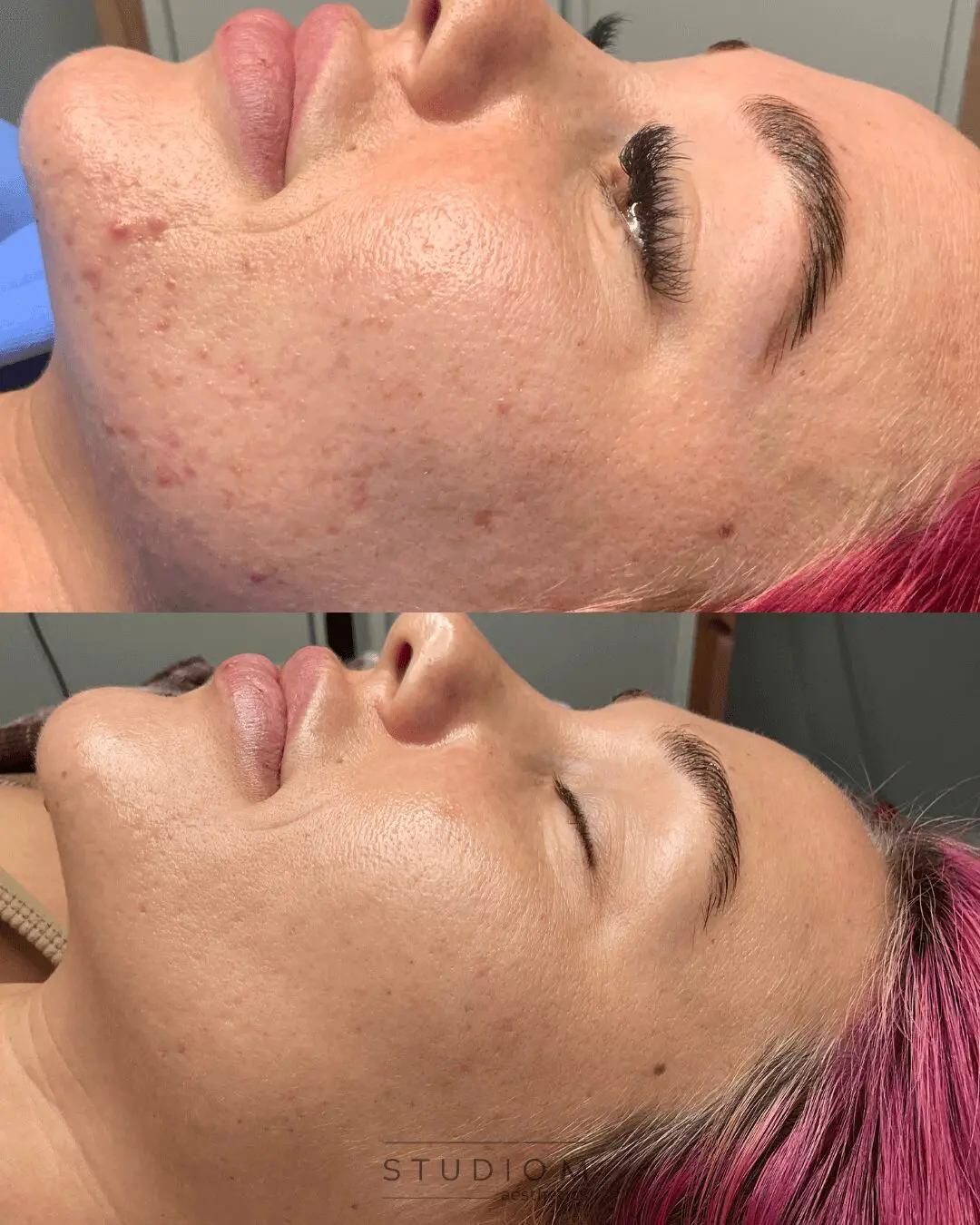 Side-by-side images show a woman's face before and after a skin treatment, highlighting reduced acne and smoother complexion.