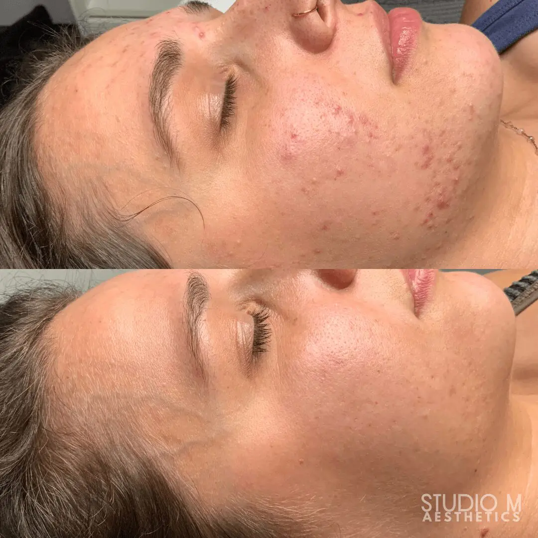 Before and after images of a person's face showing reduction in acne and smoother skin texture.