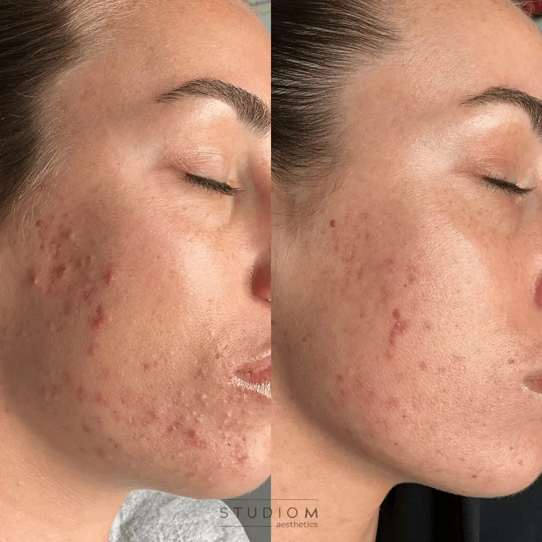 Side-by-side comparison of a person's cheek before and after acne treatment. Left shows red acne marks, right shows clear skin with reduced blemishes.