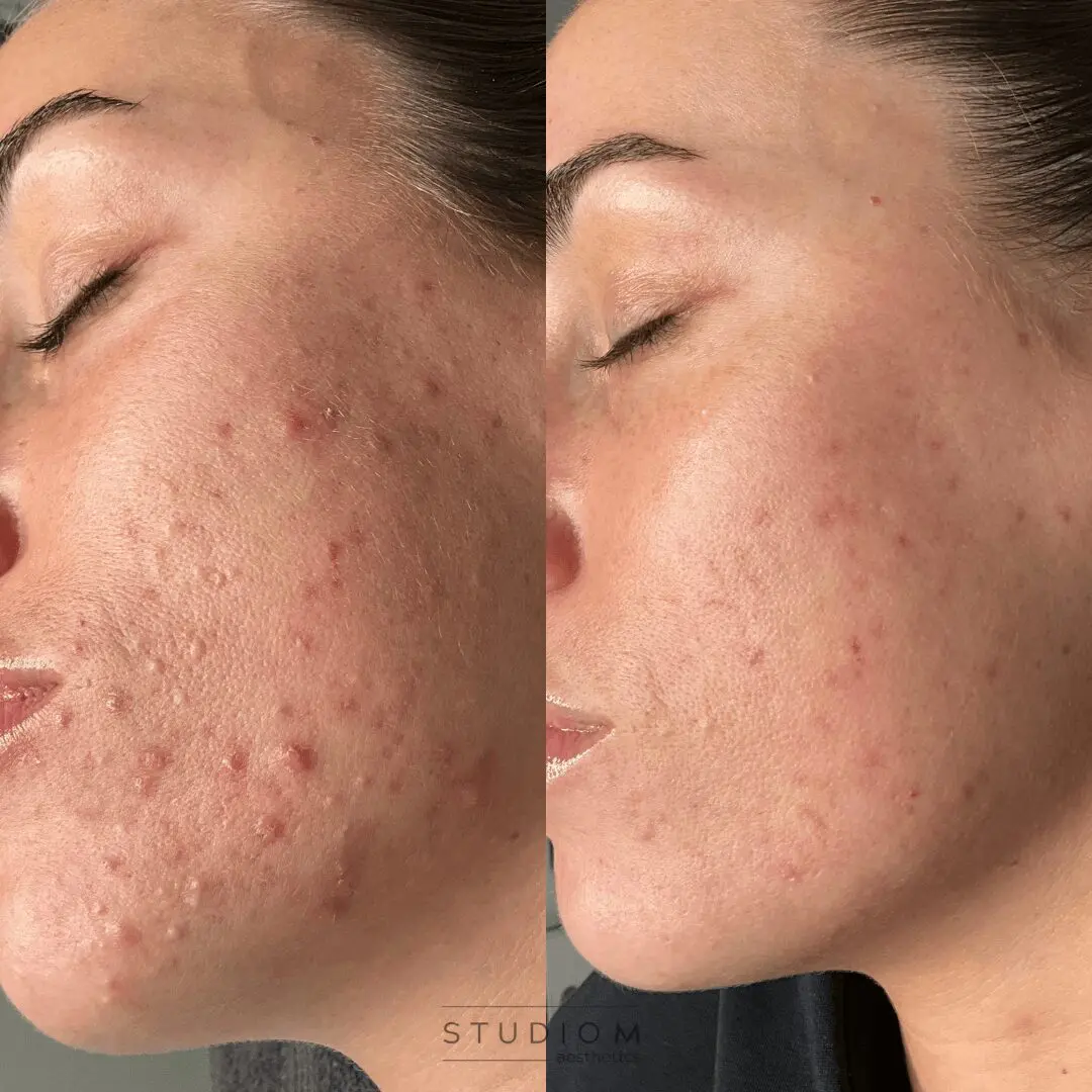 Side-by-side comparison of a person's cheek before and after skincare treatment, showing reduced redness and acne in the after image.