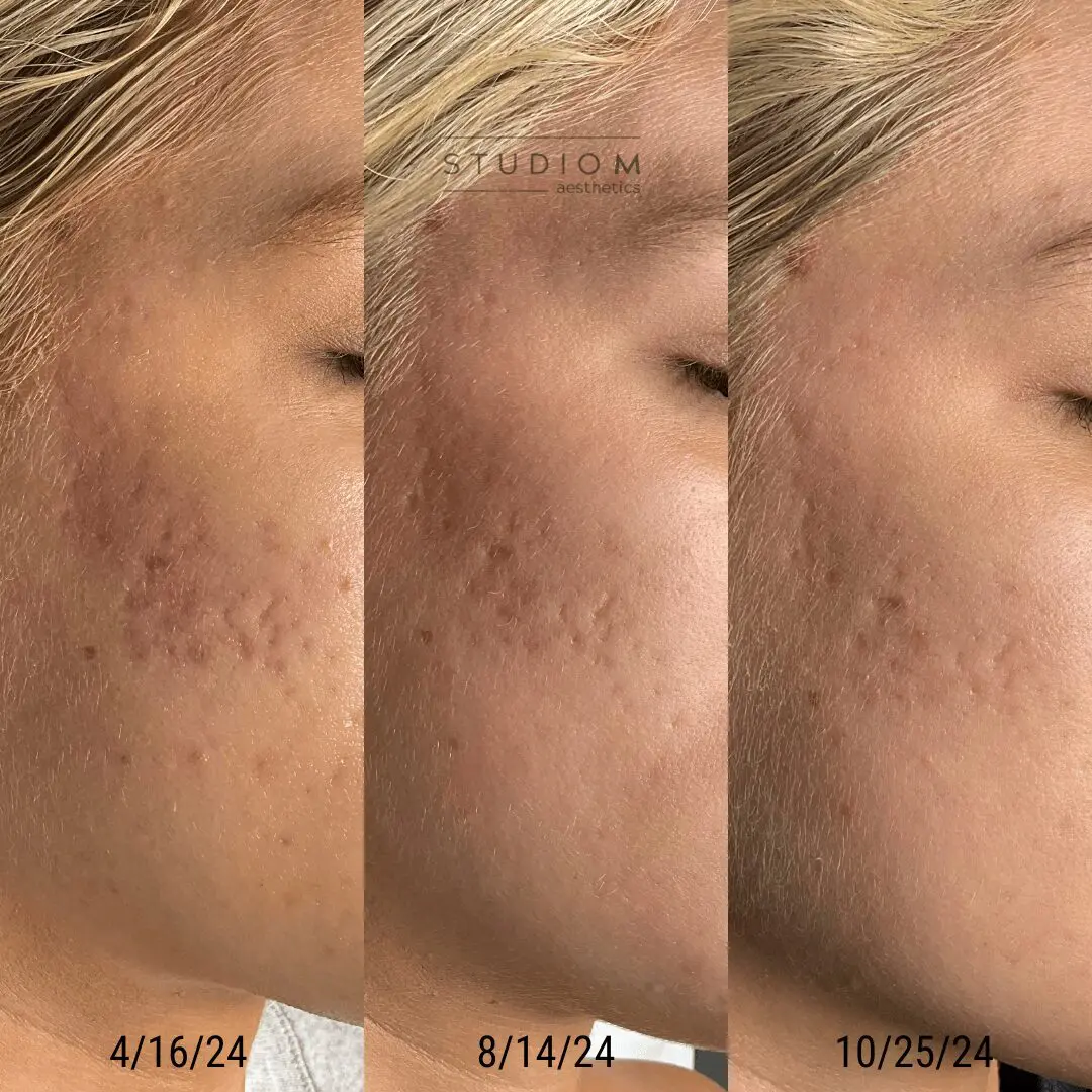 Side-by-side comparison of a person's cheek showing acne scars improving over time from April to October 2024.