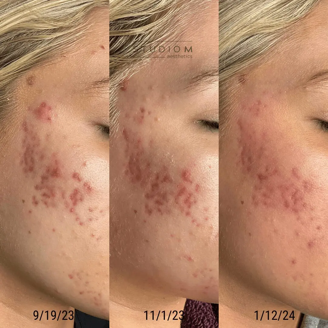 Three side-by-side images show a close-up of a person's cheek over time, displaying acne improvement. Dates are 9/19/23, 11/1/23, and 1/12/24.