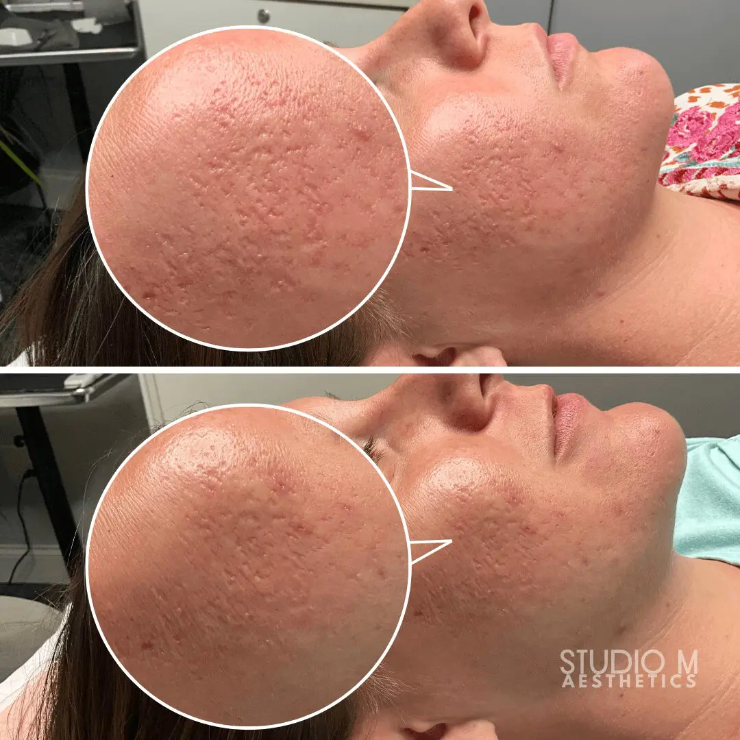 Two side-by-side images show close-ups of skin texture improvement on a person's cheek after treatment.