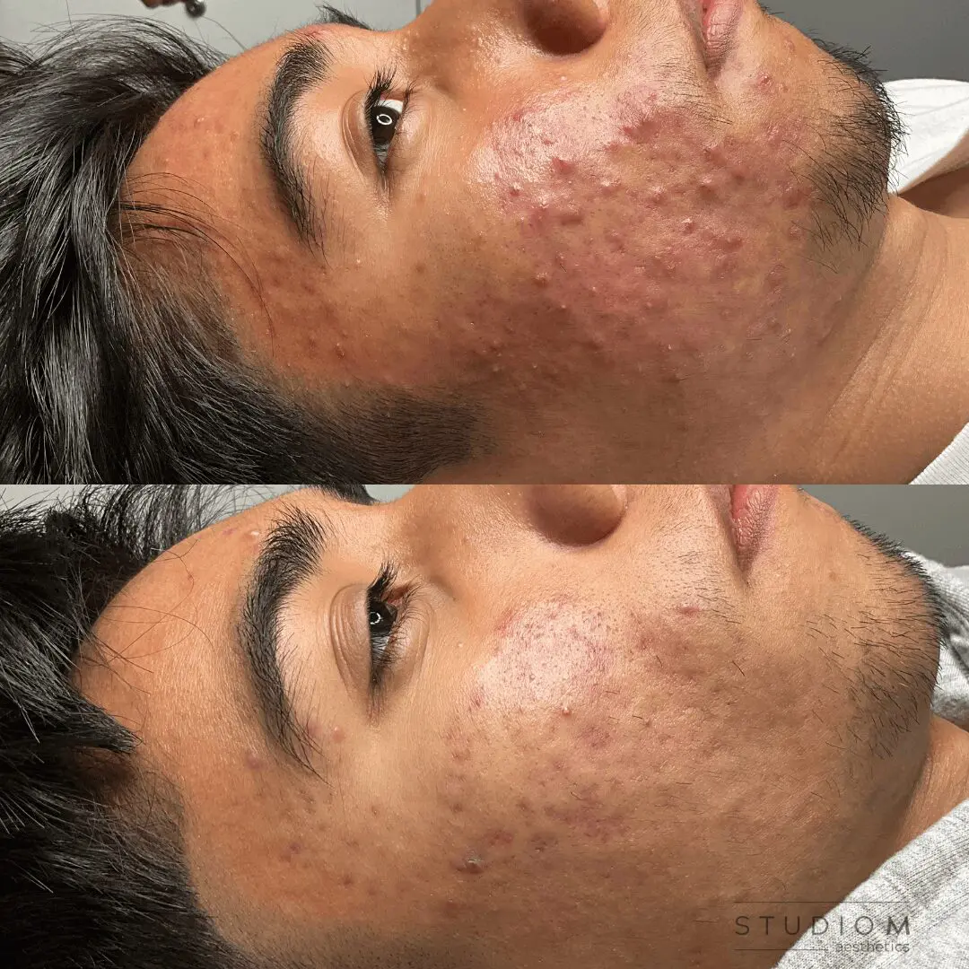 Side-by-side images of a person's face showing improvement in acne after treatment; the top image depicts more redness and acne, the bottom image shows clearer skin with reduced redness.
