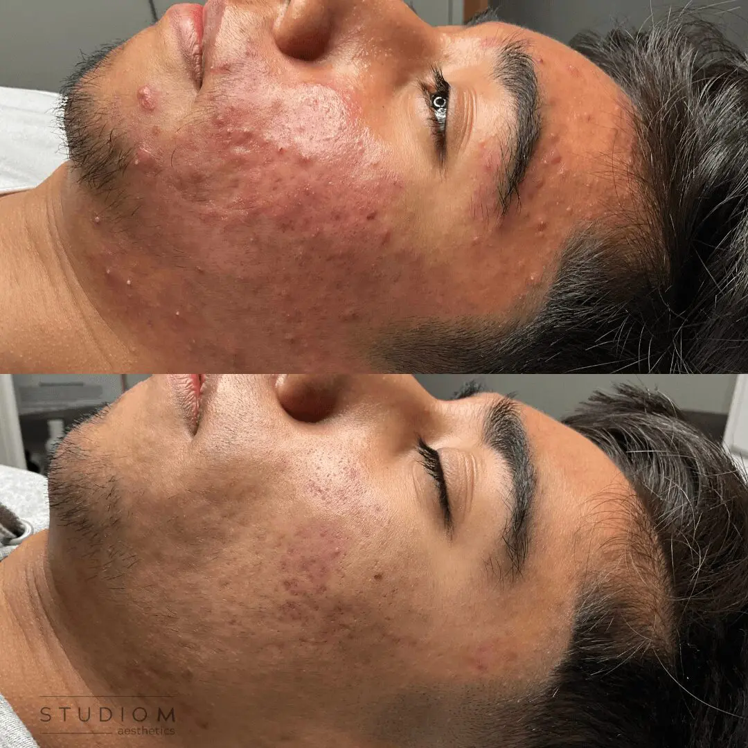 Before and after images showing improvement in facial acne. Top image shows more redness and pimples, bottom image shows reduced acne and smoother skin.