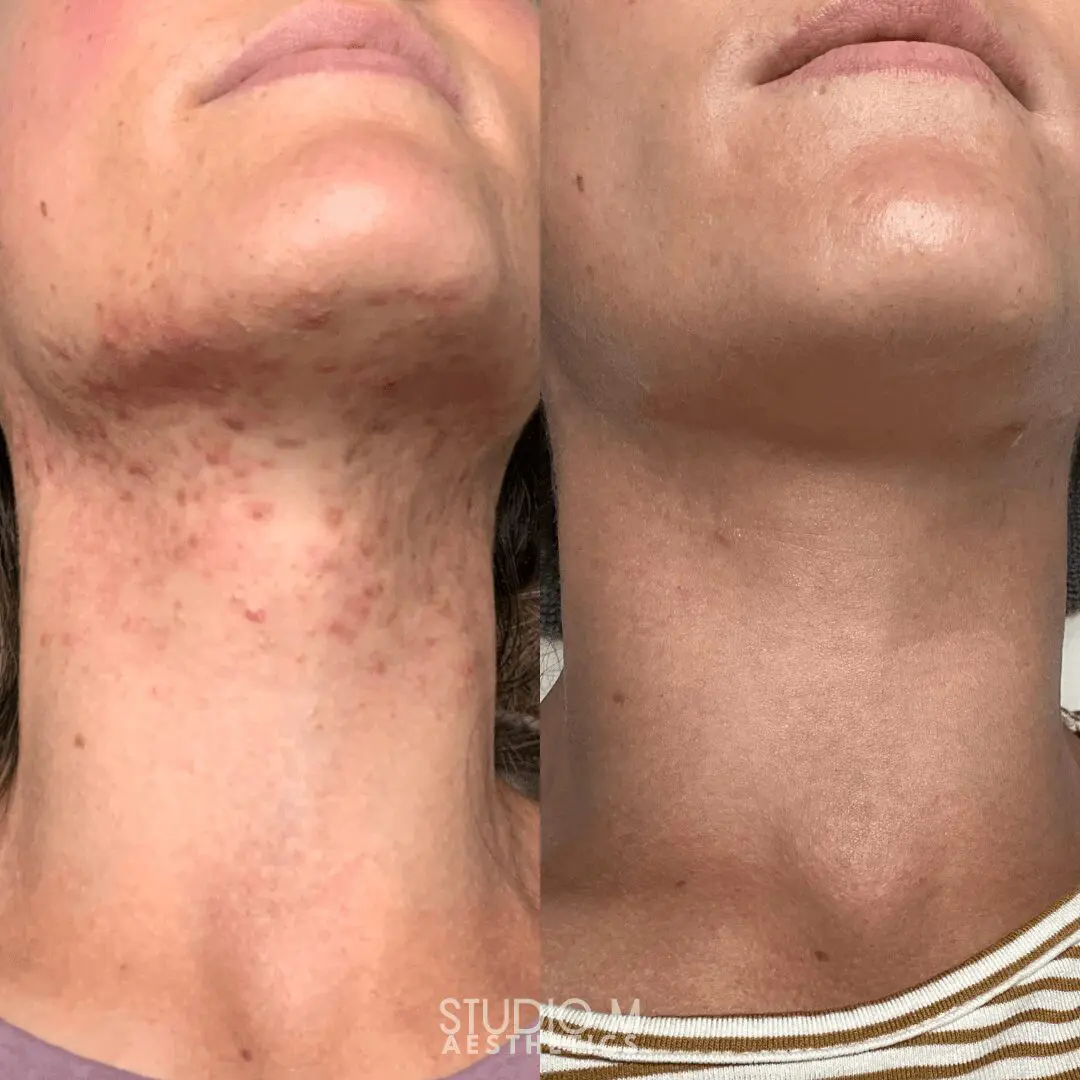 Side-by-side comparison of a neck before and after acne treatment, showing red blemishes on the left and clear skin on the right.