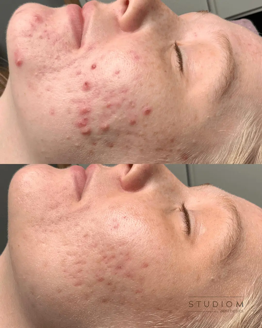 Close-up of a person's face showing improvement in skin condition. The top image shows prominent acne; the bottom image shows reduced acne and smoother skin.