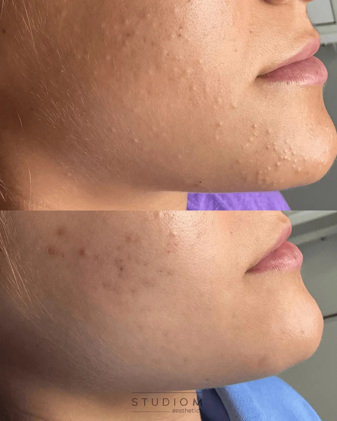Two close-up side profile images of a person's face showing skin texture before (top) and smoother skin after (bottom) a treatment.
