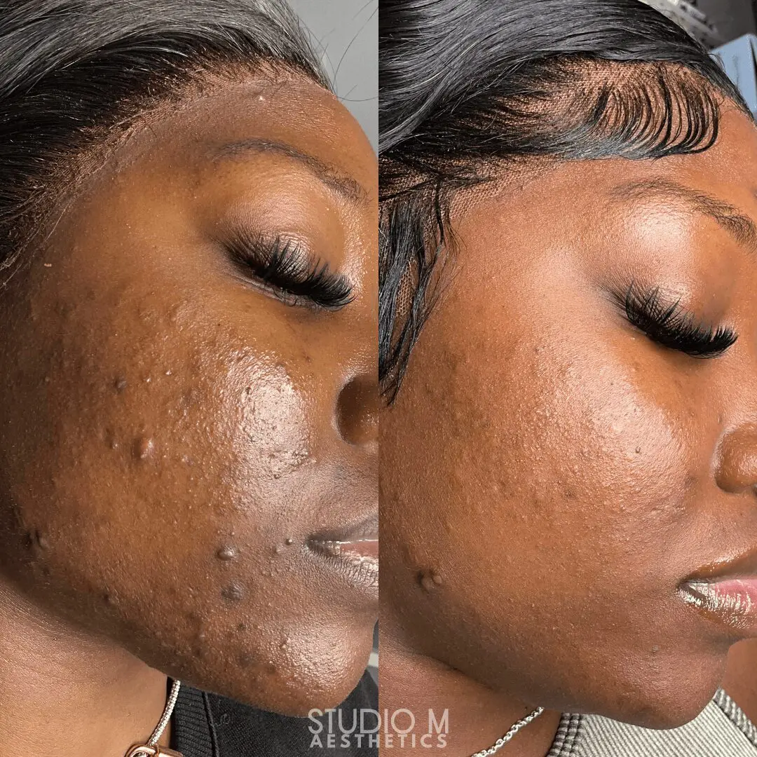 Side-by-side comparison of a person's cheek showing acne before treatment on the left and clearer skin after treatment on the right.