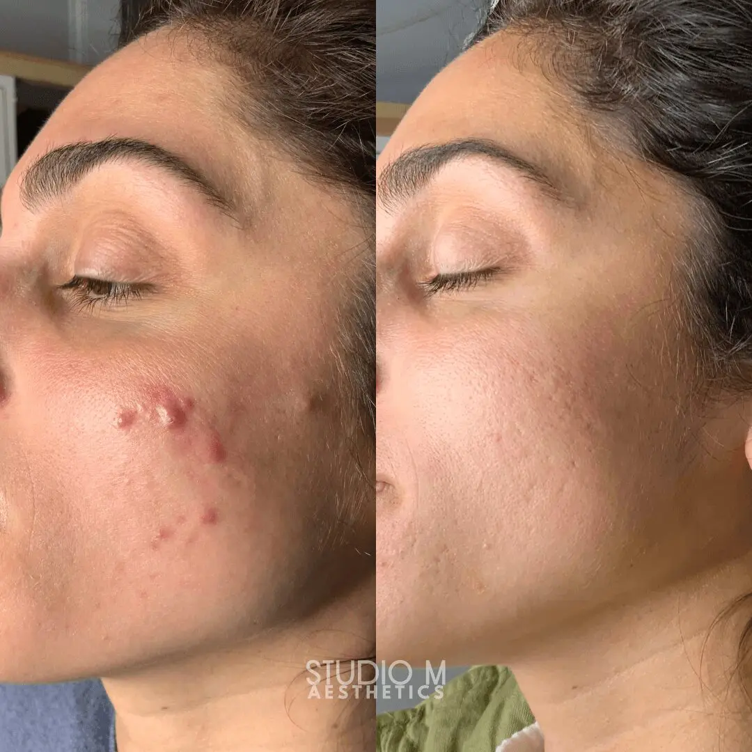 Side-by-side images of a person's cheek showing acne blemishes in the left image and clear skin in the right, both with eyes closed.