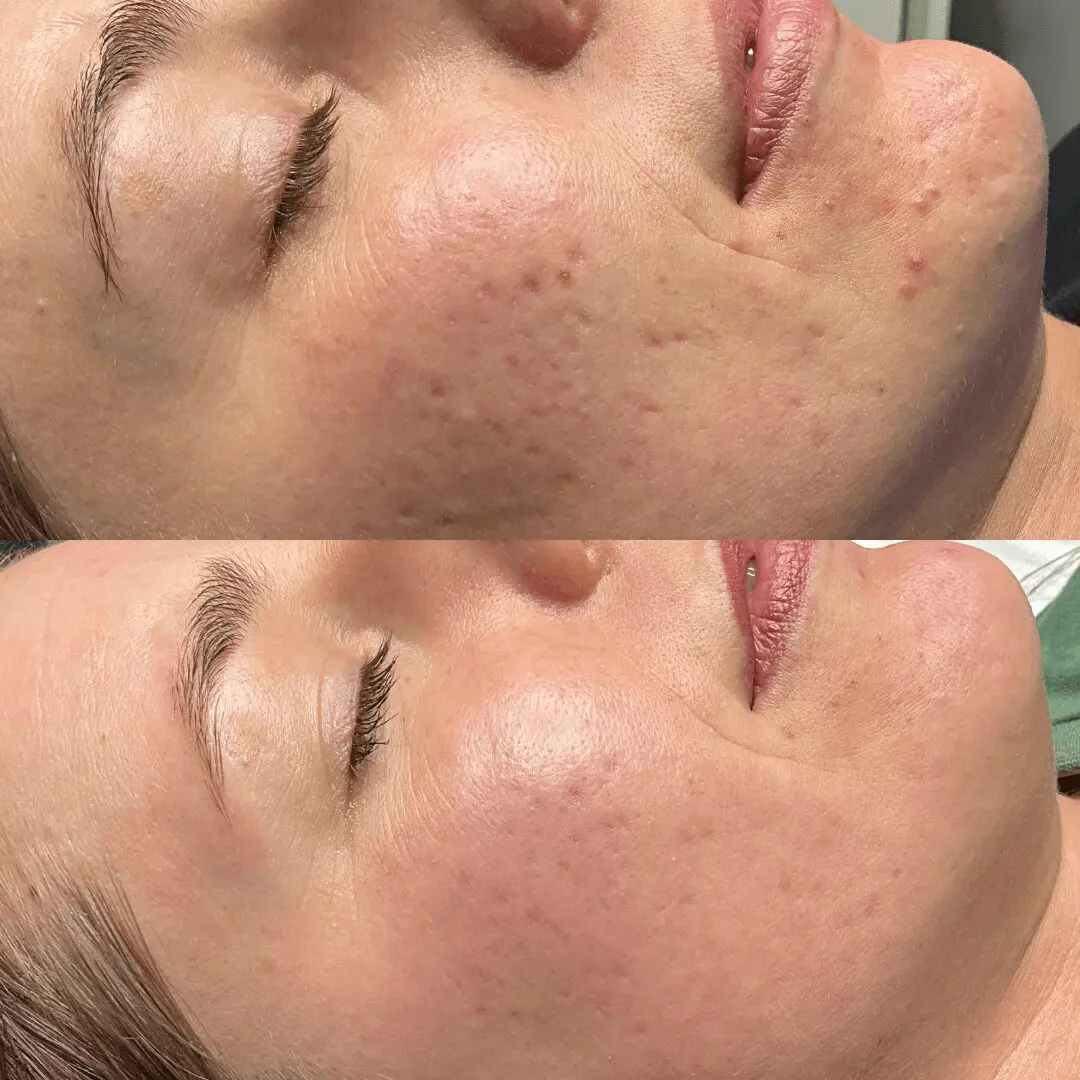 Close-up of a person's face shown in two images. Top image shows visible blemishes and uneven skin texture; bottom image shows smoother skin and reduced blemishes. Both images focus on the cheek area.