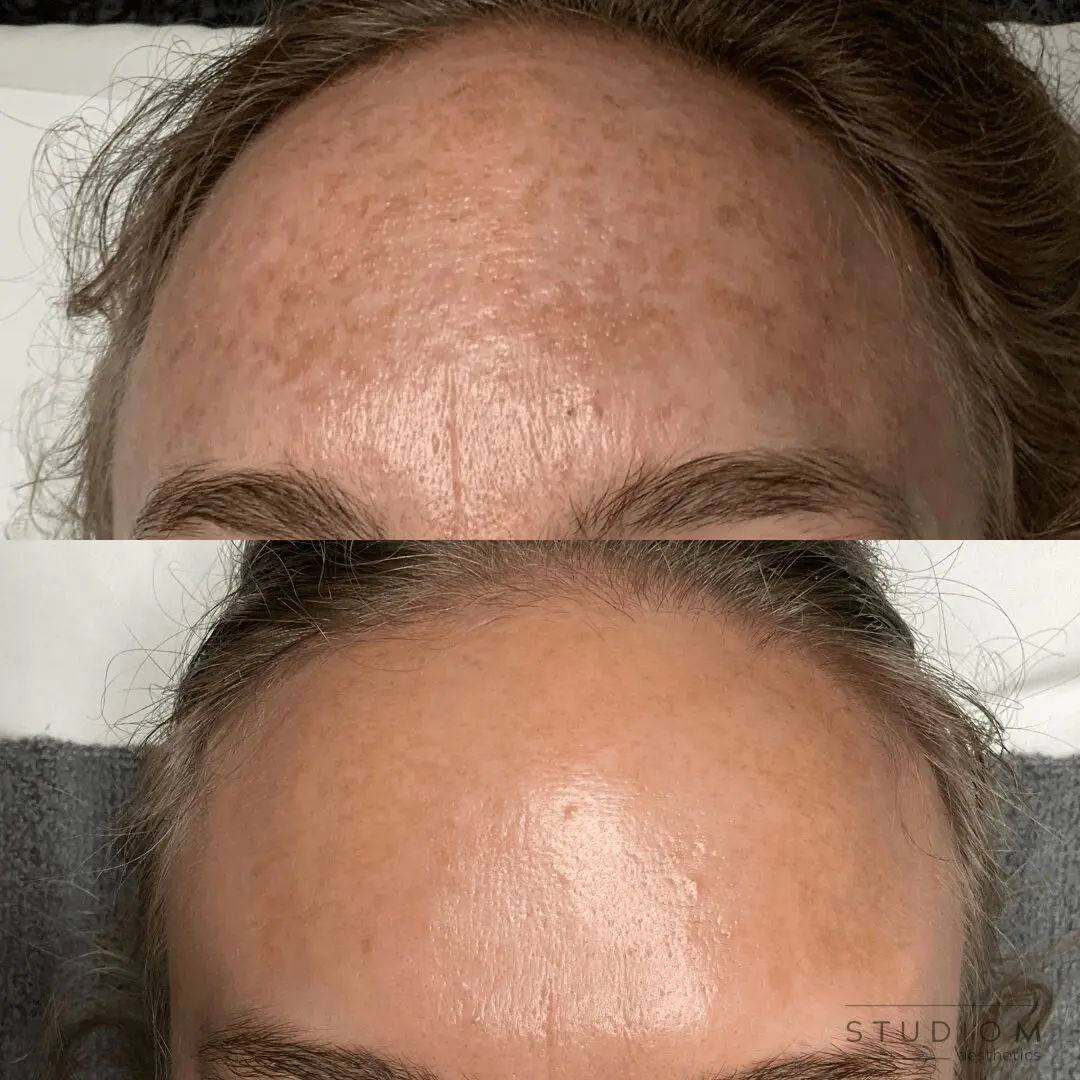 Comparison image of a forehead before and after a skin treatment. The top shows uneven texture and spots; the bottom appears smoother and more even.