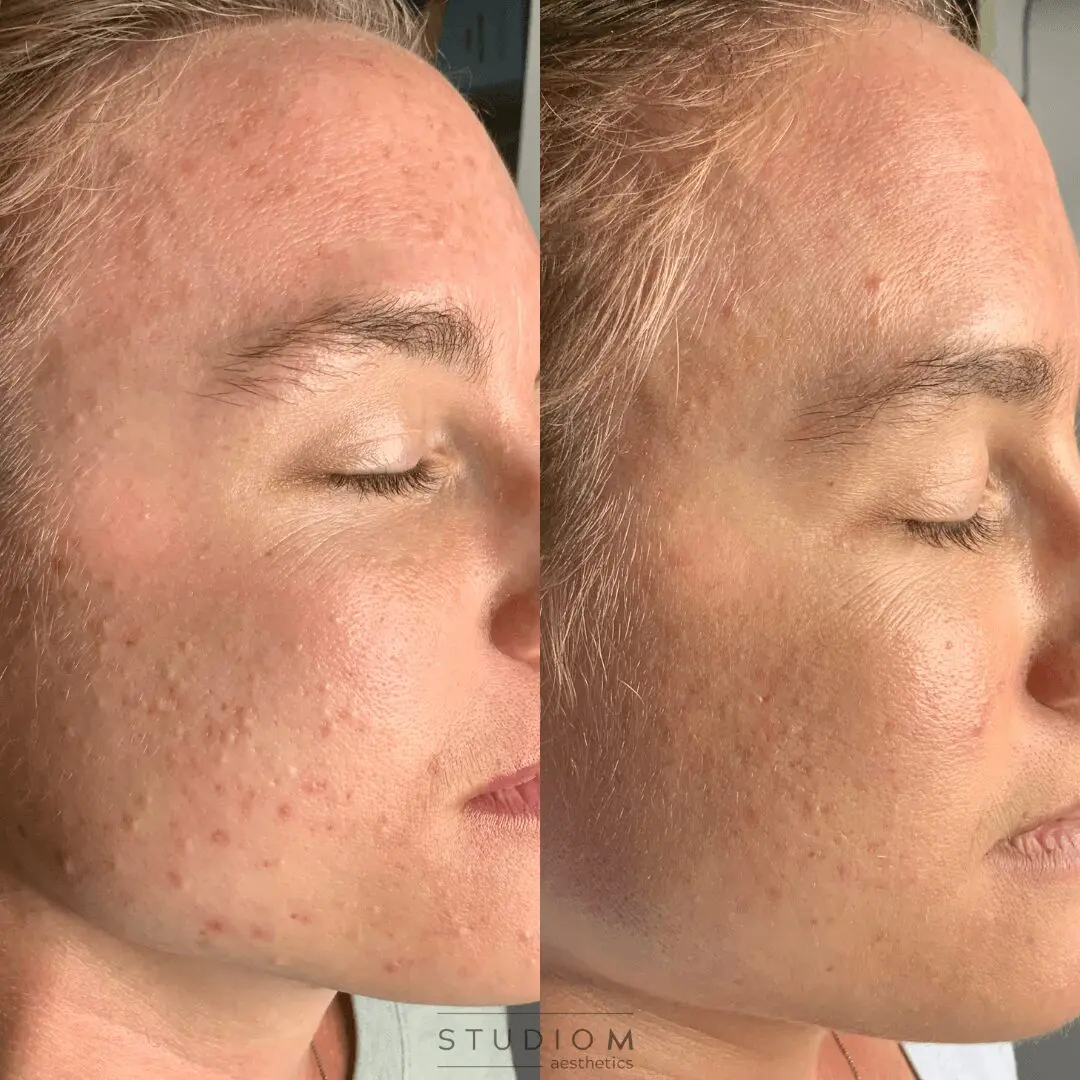 Close-up of a person's face showing skin improvement. Left: red spots and uneven texture. Right: smoother skin with reduced redness and clearer complexion.