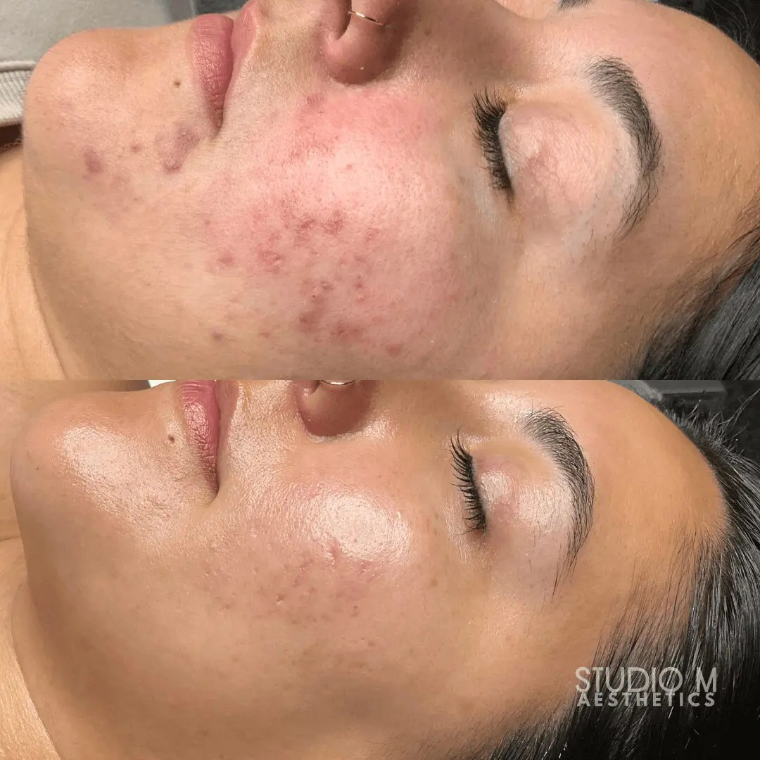 Close-up side-by-side images show a woman's face before and after skin treatment. The top image has noticeable acne and redness, while the bottom shows smoother and clearer skin.