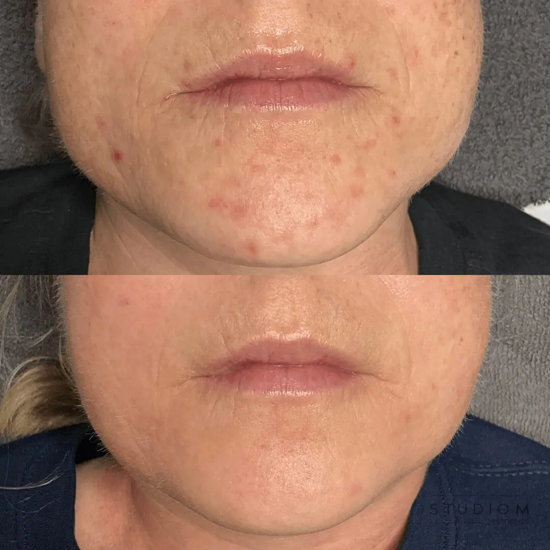 Close-up of a person's lower face; the top image shows skin with redness and bumps, while the bottom image shows smoother, clearer skin.