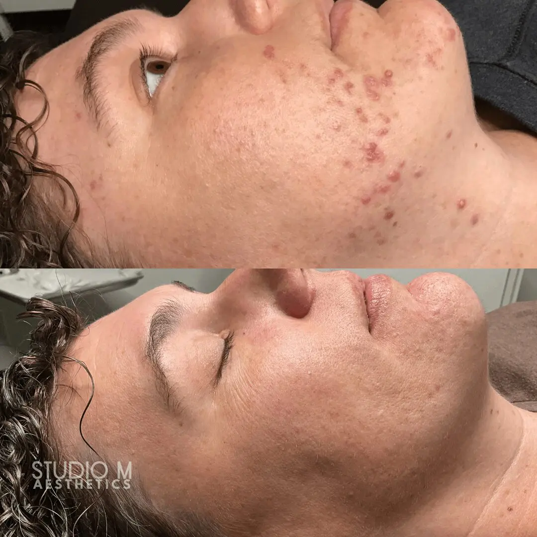 Two-part image showing a person's face before and after skincare treatment. Top: Acne on chin and cheeks. Bottom: Clear skin with reduced redness and blemishes.