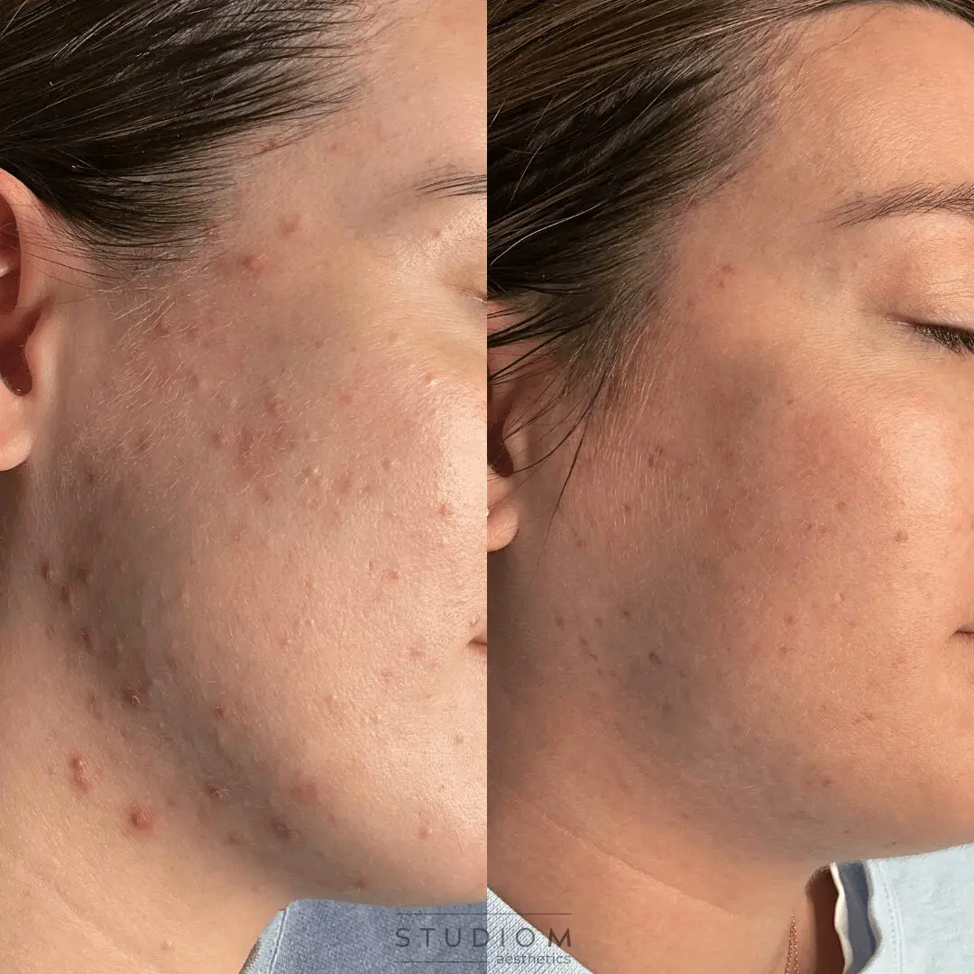 Before and after images showing the reduction of acne and clearer skin on a person's face.