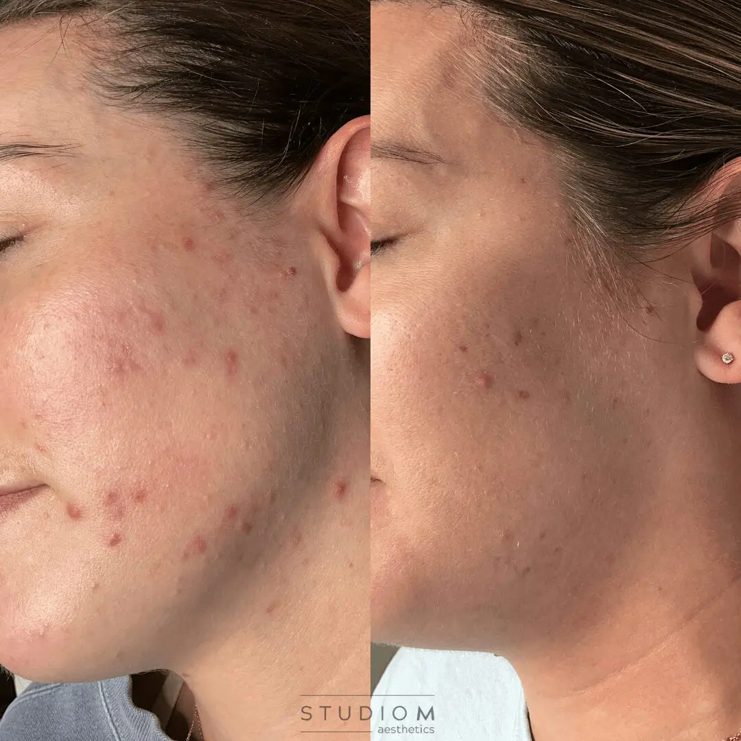 Side-by-side comparison of a person's cheek before and after acne treatment, showing a reduction in redness and blemishes.