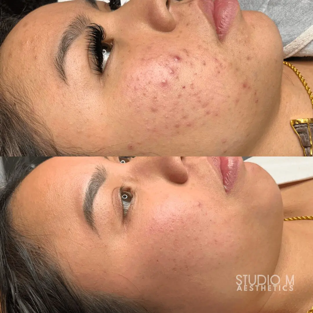 Two side-by-side images showing a woman's face before and after a skin treatment. The top image displays acne and redness, while the bottom image shows smoother skin with reduced blemishes.