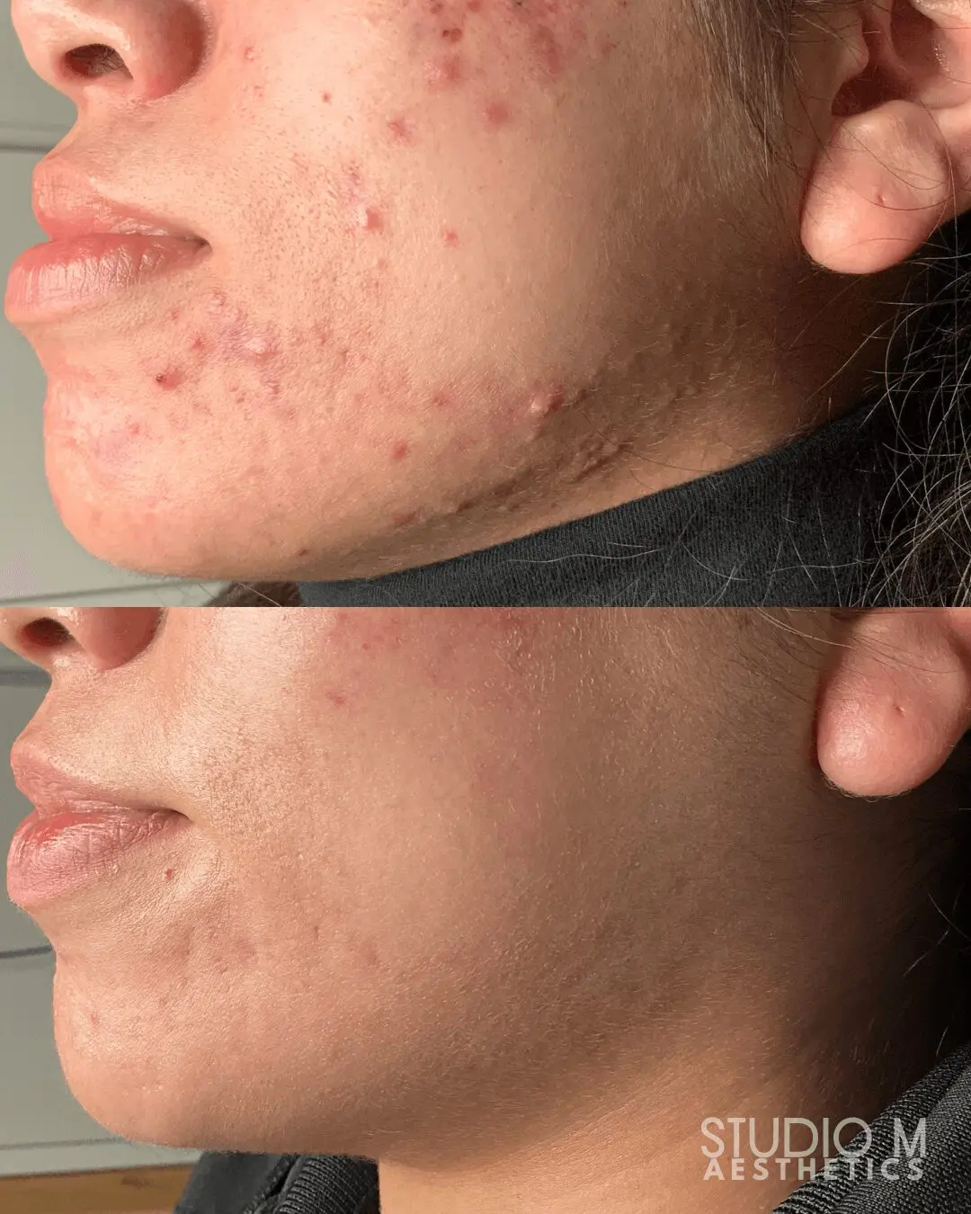 Two side-by-side close-up images of a person's face showing acne improvement over time. The top image shows more acne and blemishes compared to the clearer skin in the bottom image.