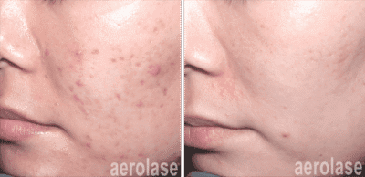 Before and after acne treatment showing clear skin improvement.